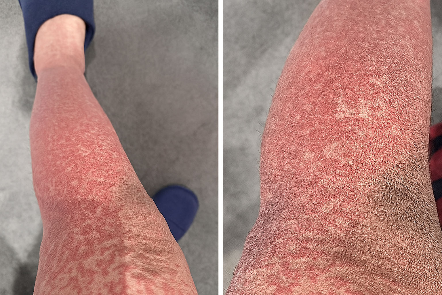 Don’t Ignore Those Itchy Red Bumps—Scabies Infections Are on the Rise